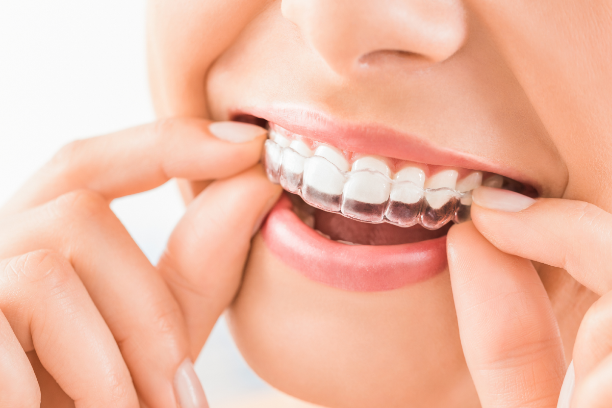 İnvisalign